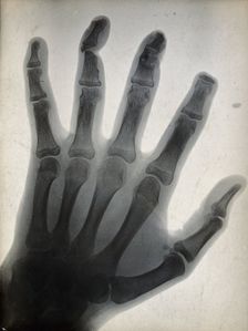 The bones of a hand, with the tip of the index finger missing, viewed through x-ray, 1896