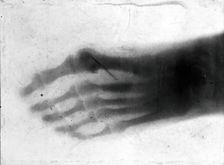 The bones of a pantomime artist's foot, viewed through x-ray; revealing a needle by one of..., 1896. Creator: Unknown
