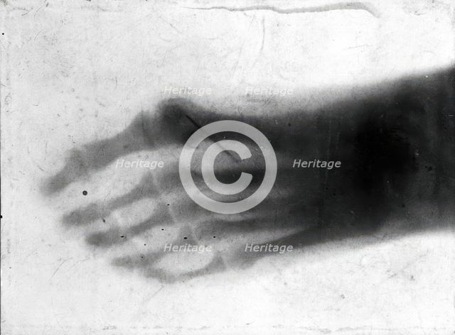 The bones of a pantomime artist's foot, viewed through x-ray; revealing a needle by one of..., 1896. Creator: Unknown.