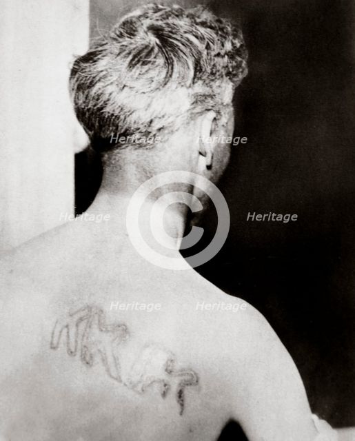 The branded back of Reverend Orrin Van Loon, Detroit, Michigan, USA, July 1924.  Creator: Unknown.
