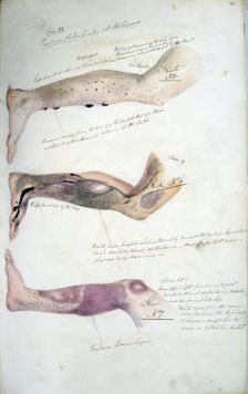 The effects of scurvy, February 1841. Creator: Henry Walsh Mahon