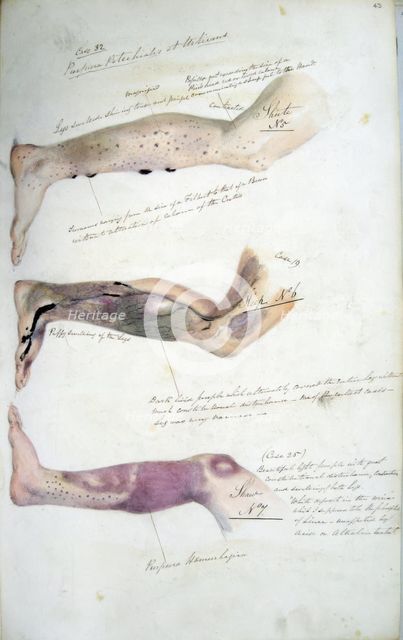 The effects of scurvy, February 1841. Creator: Henry Walsh Mahon.