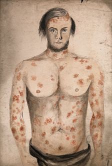 The face, arms and torso of a man suffering from diseased skin and abcesses (?), between 1800 & 1899 Creator: Christopher D'Alton