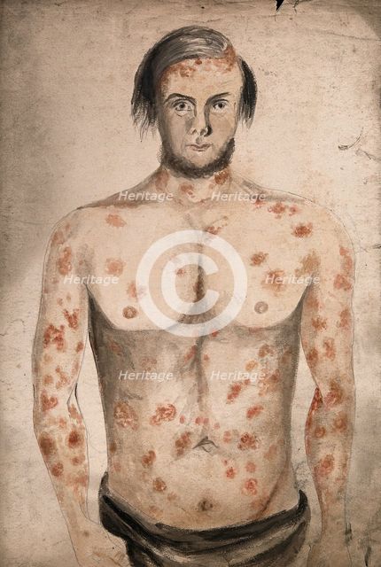 The face, arms and torso of a man suffering from diseased skin and abcesses (?), between 1800 & 1899 Creator: Christopher D'Alton.