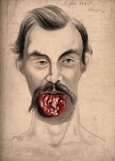 The face of a man suffering from cancer of the tongue, showing severely diseased tissue..., 1867. Creator: Christopher D'Alton