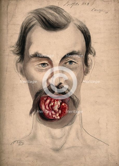 The face of a man suffering from cancer of the tongue, showing severely diseased tissue..., 1867. Creator: Christopher D'Alton.