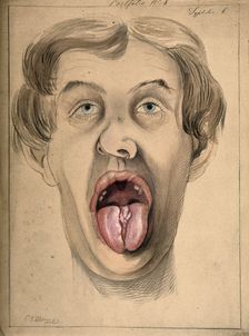 The face of a man suffering from syphilis, shown with mouth open wide, displaying areas of..., 1869. Creator: Christopher D'Alton