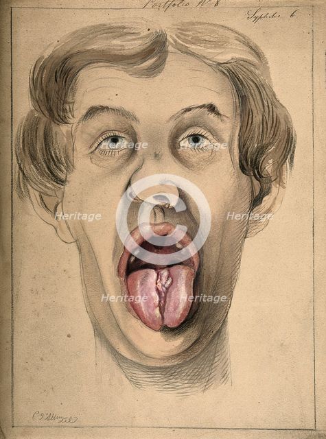The face of a man suffering from syphilis, shown with mouth open wide, displaying areas of..., 1869. Creator: Christopher D'Alton.