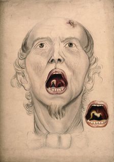 The face of a man, with mouth open wide, displaying a diseased area of tissue on the soft..., 1866. Creator: Christopher D'Alton