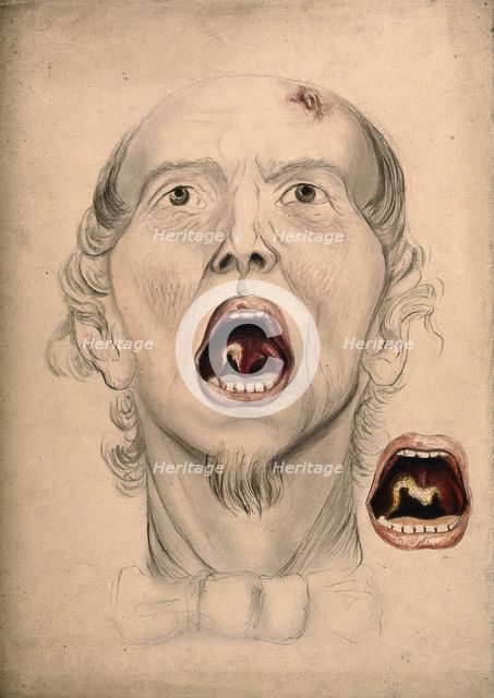 The face of a man, with mouth open wide, displaying a diseased area of tissue on the soft..., 1866. Creator: Christopher D'Alton.