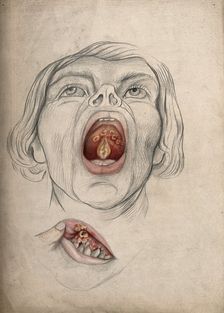 The face of a man, with mouth open wide, displaying diseased areas of..., between 1800 and 1899. Creator: Christopher D'Alton
