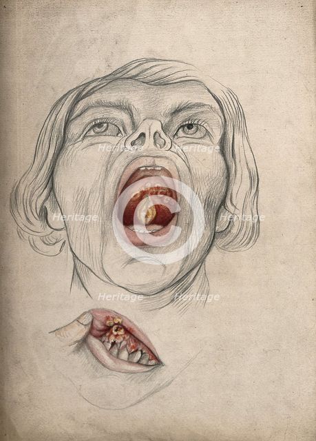 The face of a man, with mouth open wide, displaying diseased areas of..., between 1800 and 1899. Creator: Christopher D'Alton.