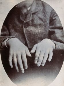 The hands of a child, showing deformity, particularly around the fingertips, c1890s. Creator: N. Goulton May