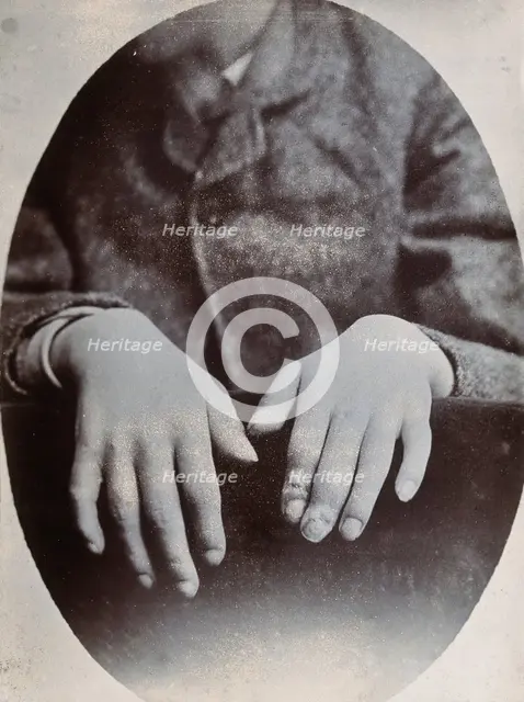 The hands of a child, showing deformity, particularly around the fingertips, c1890s. Creator: N. Goulton May.