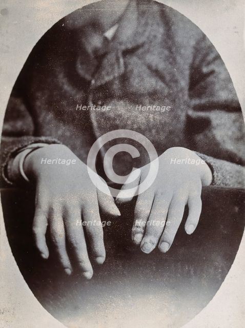 The hands of a child, showing deformity, particularly around the fingertips, c1890s. Creator: N. Goulton May.