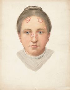 The head of a young woman with loss of skin on her forehead and nose, (1900?). Creator: Jonathan Hutchinson