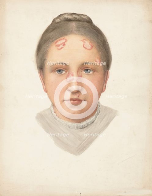The head of a young woman with loss of skin on her forehead and nose, (1900?). Creator: Jonathan Hutchinson.
