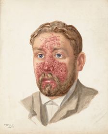 The head of a man with skin disease, July 1889. Creator: W Toogood Hill