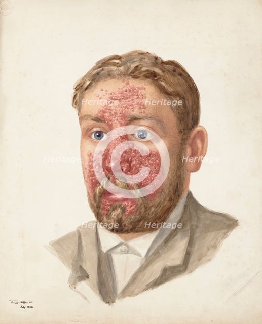 The head of a man with skin disease, July 1889. Creator: W Toogood Hill.