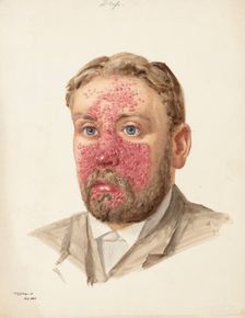 The head of a man with skin disease, July 1889. Creator: W Toogood Hill