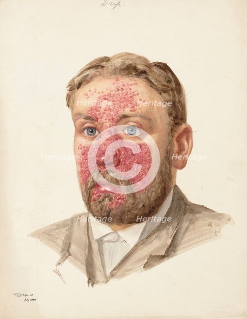 The head of a man with skin disease, July 1889. Creator: W Toogood Hill.