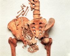 The pelvis of a young Medieval woman. Creator: Unknown