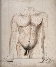 The torso, arms and upper thighs of a man suffering from a rash of sores, (1853?). Creator: Christopher D'Alton
