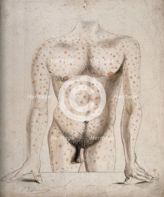 The torso, arms and upper thighs of a man suffering from a rash of sores, (1853?). Creator: Christopher D'Alton.