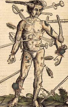The wound man, 1517. Creator: Hans Wechtlin the Elder