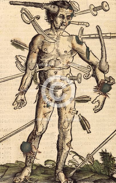 The wound man, 1517.  Creator: Hans Wechtlin the Elder.