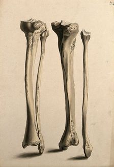 Tibia and fibula bones, 1830-1835. Creator: Unknown