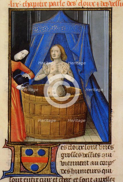 Treatment of boils with a hot herbal bath. From Livre des propriétés des choses by Barthélemy l'Angl Creator: Anonymous.