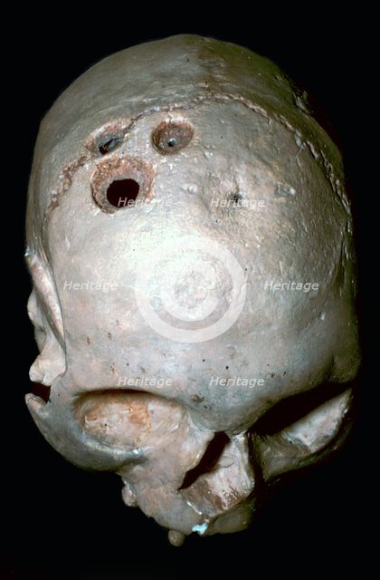 Trepanned Skull. Artist: Unknown