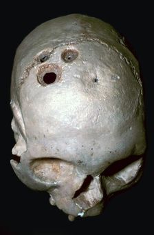 Trepanned Skull