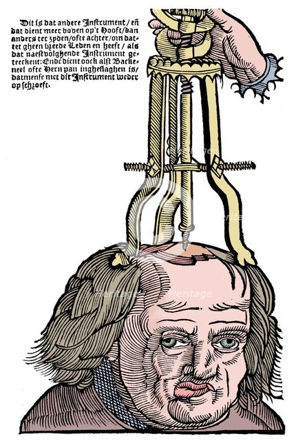 Trephination, 1593. Artist: Unknown.