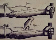 Two arms, and a finger pointing towards a vein, 1628. Creator: Unknown