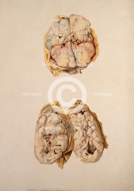 Two diseased parts of the body. Creator: Unknown.