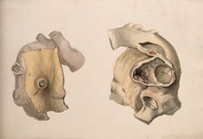 Two diseased parts of the body. Creator: Unknown