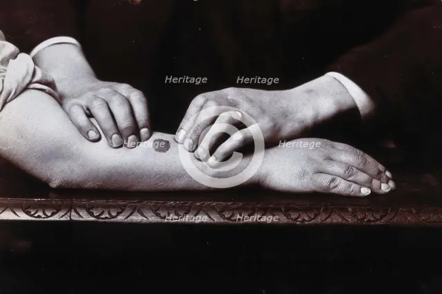 Two hands held on either side of a dark mark on a forearm, to demonstrate...., c1920s. Creator: Unknown.