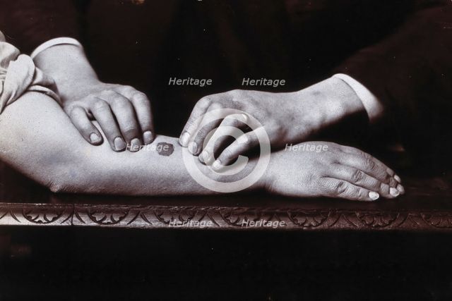 Two hands held on either side of a dark mark on a forearm, to demonstrate...., c1920s. Creator: Unknown.