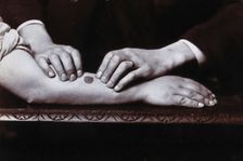 Two hands held on either side of a dark mark on a forearm, to demonstrate...., c1920s. Creator: Unknown