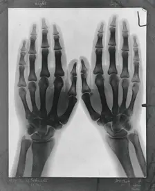Two hands, viewed through x-ray, 1896