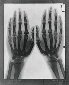 Two hands, viewed through x-ray, 1896