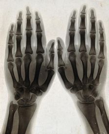 Two hands, viewed through x-ray, 1896