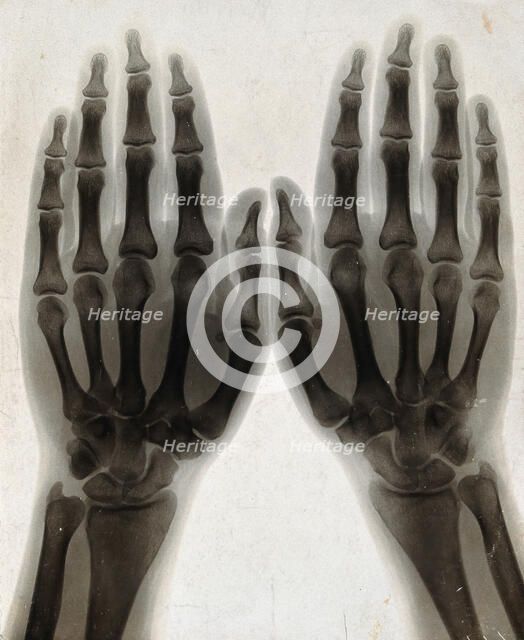Two hands, viewed through x-ray, 1896.