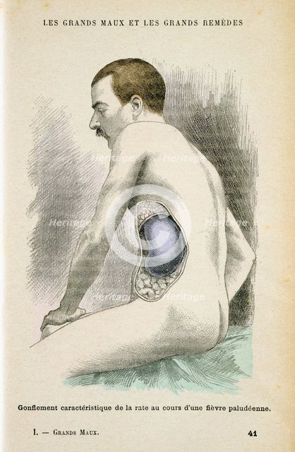 Typical enlarged spleen of a Malaria patient, c1890. Creator: Unknown.