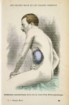Typical enlarged spleen of a Malaria patient, c1890. Creator: Unknown
