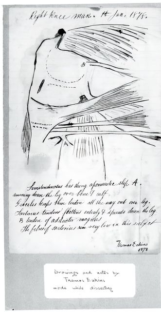 (Untitled) (Anatomical Study Of Right Knee), 1878. Creator: Thomas Eakins.
