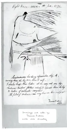 (Untitled) (Anatomical Study Of Right Knee), 1878. Creator: Thomas Eakins