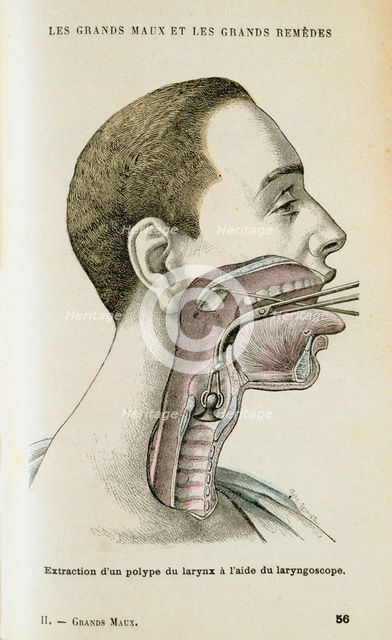 Using a laryngoscope to aid the removal of a polyp from the throat, c1890. Artist: Unknown